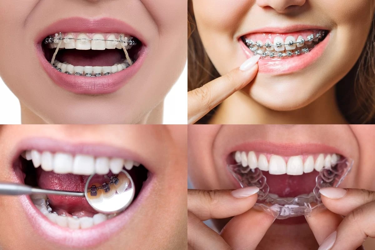 descubra as melhores opções de aparelhos dentários!