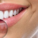 Por que o tratamento prévio é fundamental para o seu sorriso perfeito?